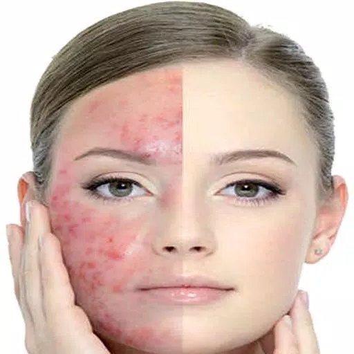 Get Rid of Acne  (Guide)应用截图第2张